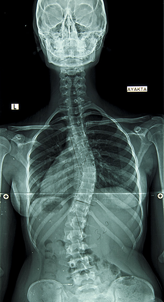 Adult Scoliosis