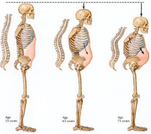 Osteoporosis-21